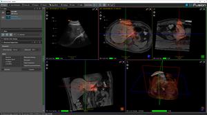 ImFusion 3D Ultrasound Suite - perpetual license